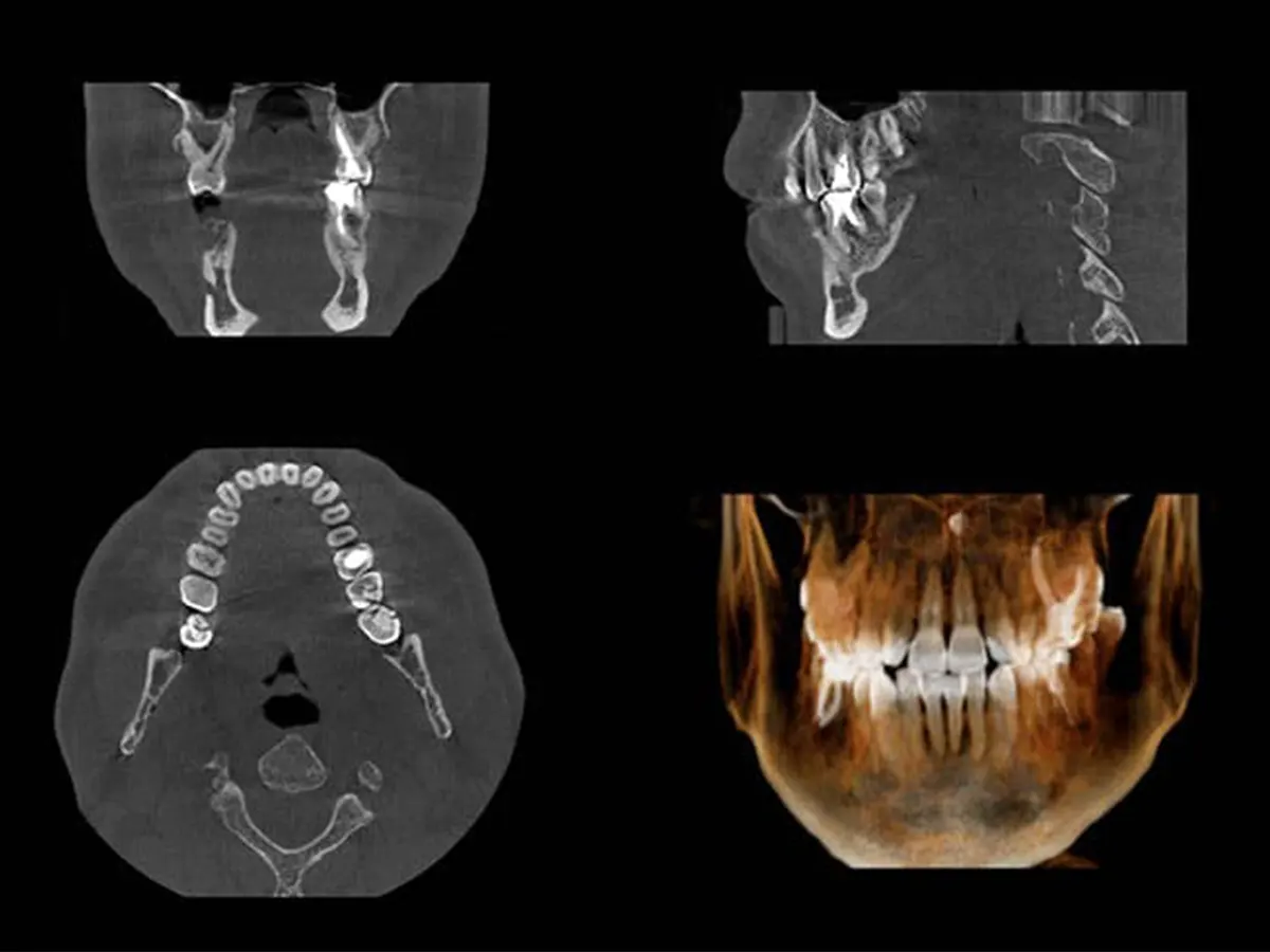3D CBCT imaging at Hammons Family Dental, used for dental implant planning