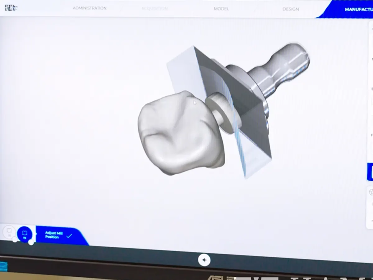 Same-day crown designed on the chairside CEREC screen at Hammons Family Dental in Georgetown, TX